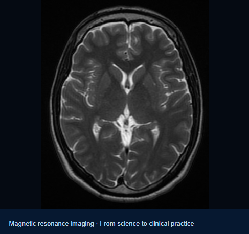 Axial T2-weighted magnetic resonance image of the human brain